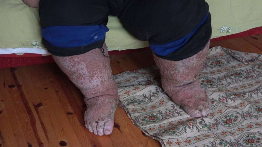 Sivrisinek, hayatının kabusu oldu! Öyle bir hastalığa yakalandı ki doktorlar çaresiz kaldı 13